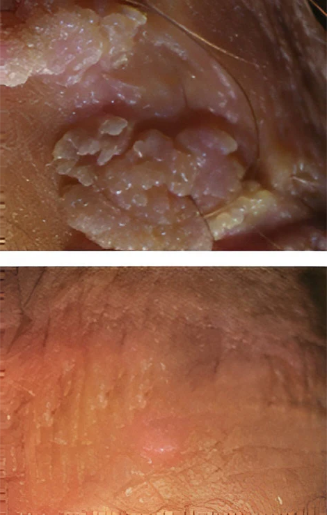 Customer reading the ClariDerm eligibility and treatment guide before use