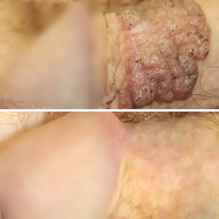 Customer holding ClariDerm at home after choosing a private treatment routine